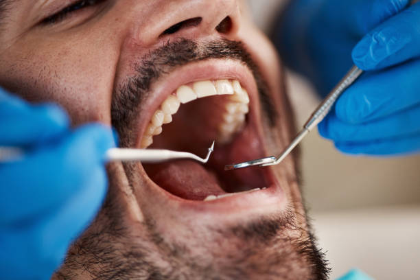 Best Emergency Root Canal Treatment in Huntersville, NC